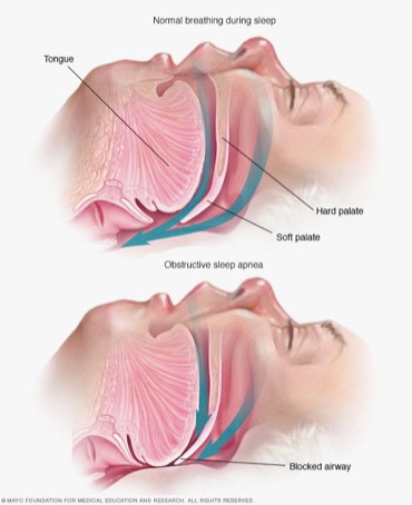Sleep apnea