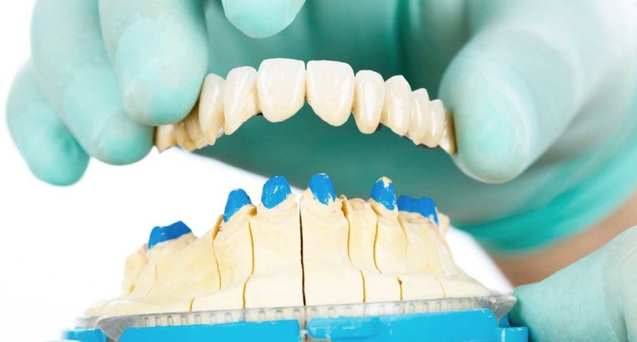 Dental bridges