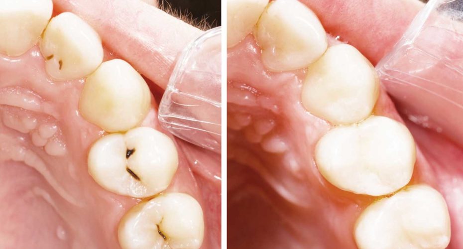 Tooth colored fillings