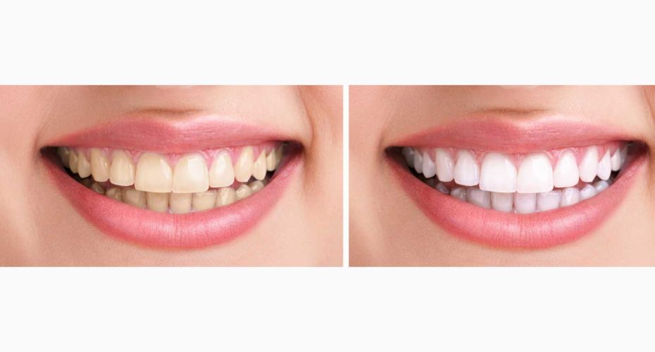Teeth whitening in Countryside, IL