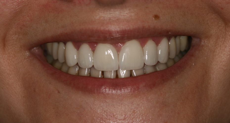 Close diastema