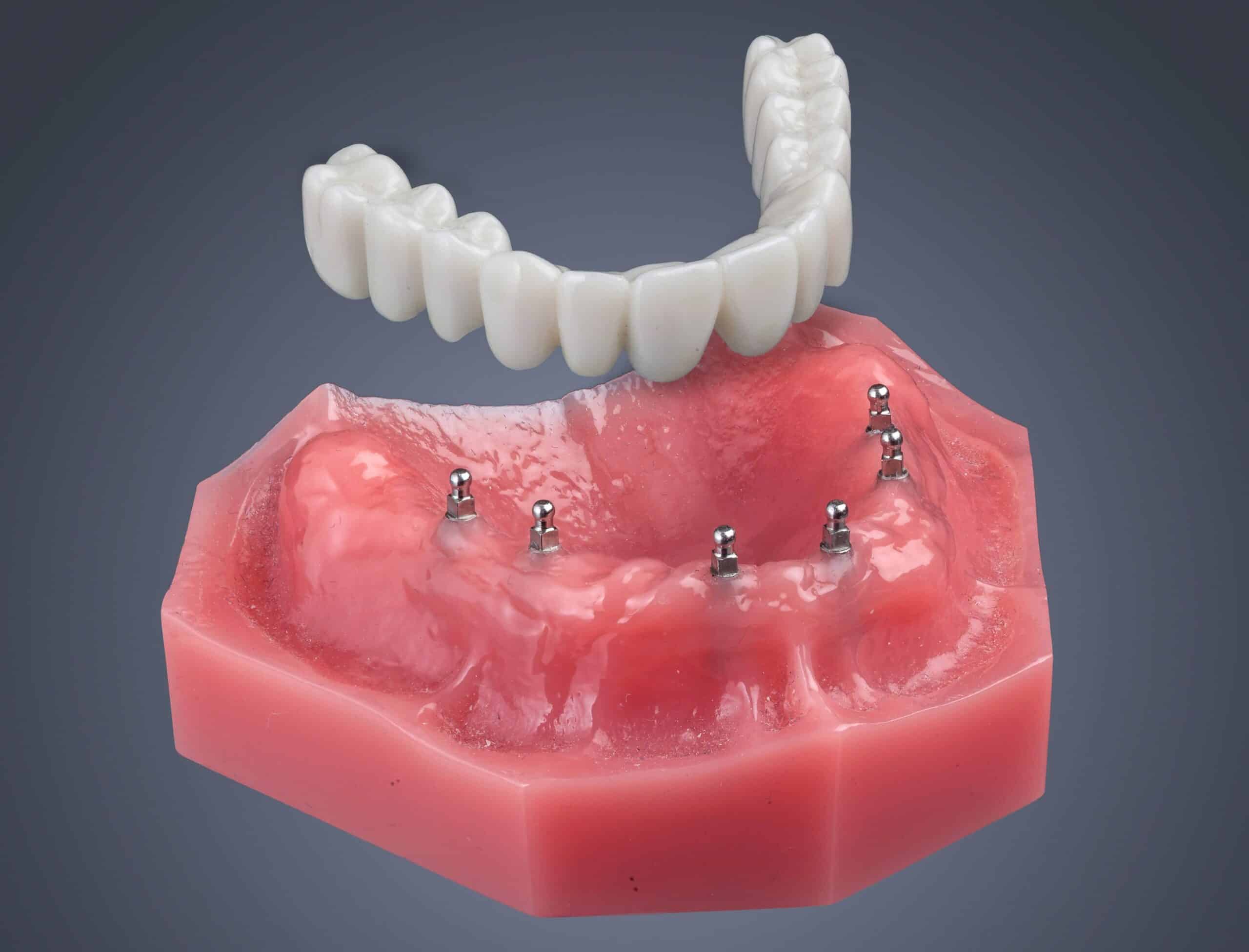 What is an Implant Retained Denture? Dental Implants in Chicago