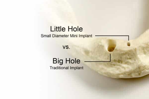 El dentista de implantes de Chicago explica las ventajas de los miniimplantes dentales