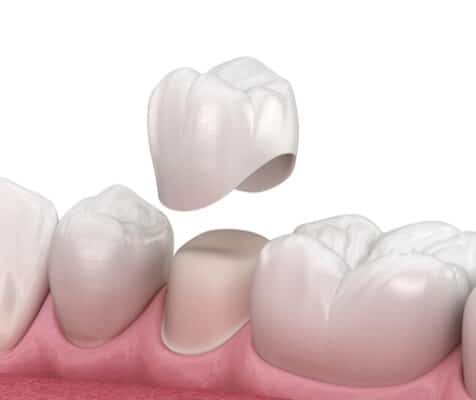 Dental Crowns in Countryside, IL