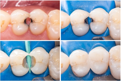 Dental Fillings in Counryside, IL Composite Fillings Hope Dental