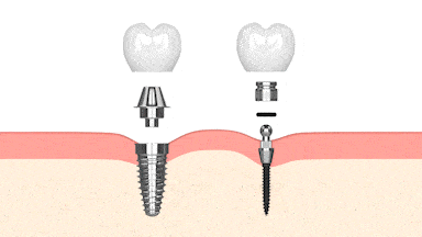 Implantes dentales tradicionales frente a miniimplantes dentales