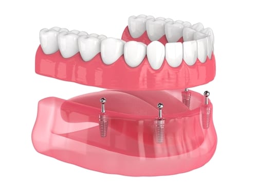 Implant Dentures in Countryside, IL Stabilize Your Loose Dentures