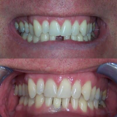 Dientes perdidos Recupere su sonrisa con miniimplantes dentales