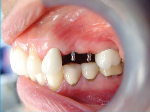 Mini Implantes vs Implantes Dentales Convencionales Hope Dental