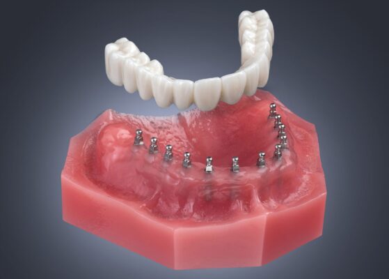 Snap-On Dentures Your Ideal Solution for Denture Stabilization
