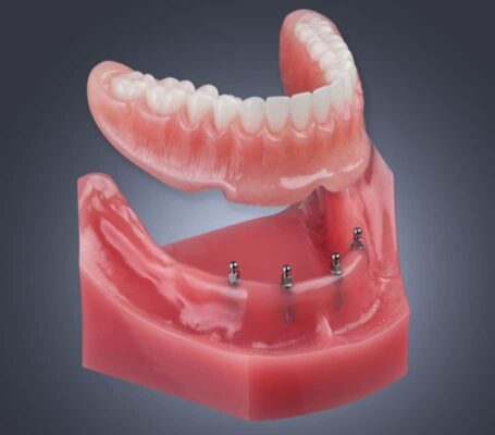 Denture Options Finding Freedom with Implant-Retained Solutions